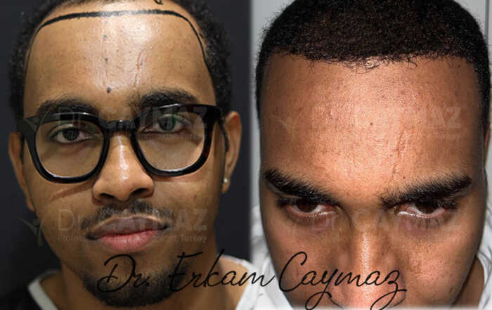 Hair Upload - Hair Transplant Turkey – Istanbul - 2026 12 https://www.hairupload.com/afro-textured-before-after/?fb-edit=1#:~:text=ATTACHMENT%20DETAILS-,10%2Dmonths%2D4000%2Dgraft,-%2D239.jpg