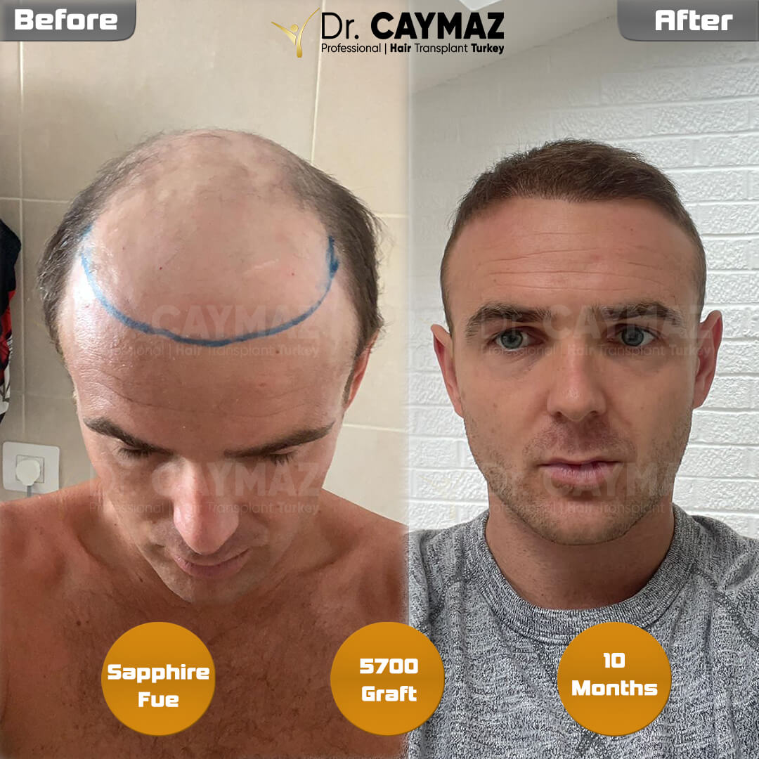 The Best 5 Hair Transplantation Clinics In The World