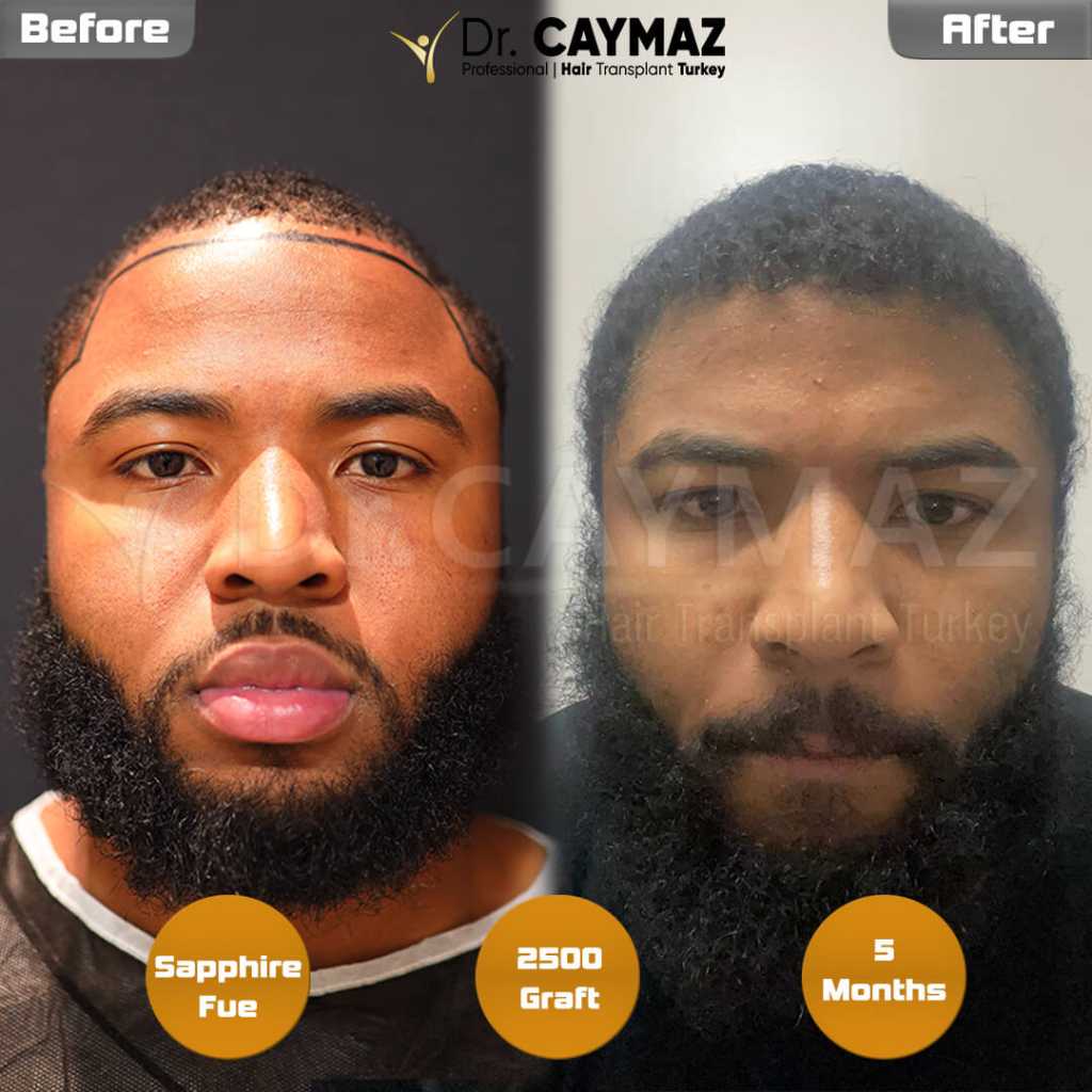 African American Hair Transplantation 2 2500-graft-5000-graft-1