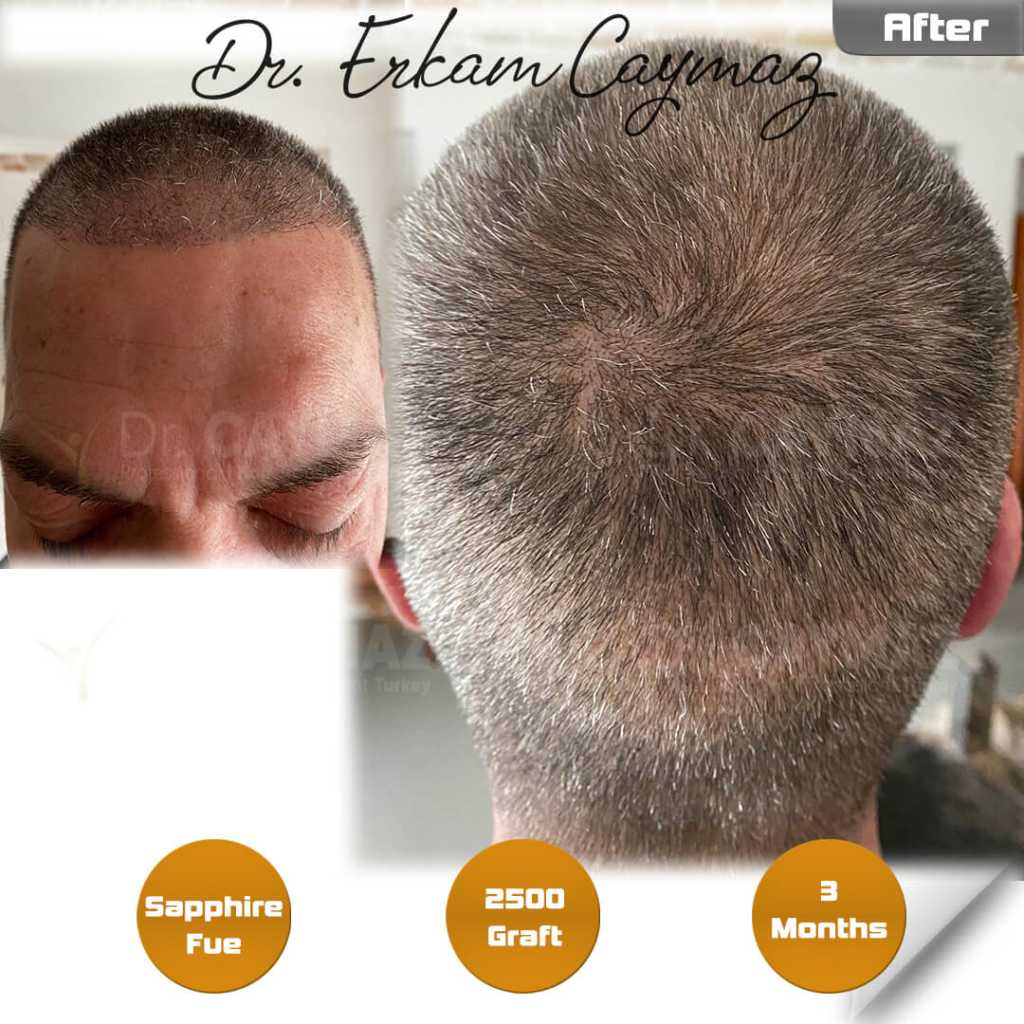 Hair Transplant Scars: FUE Dots vs. FUT Strip & Minimising Visibility 4 3 months 234