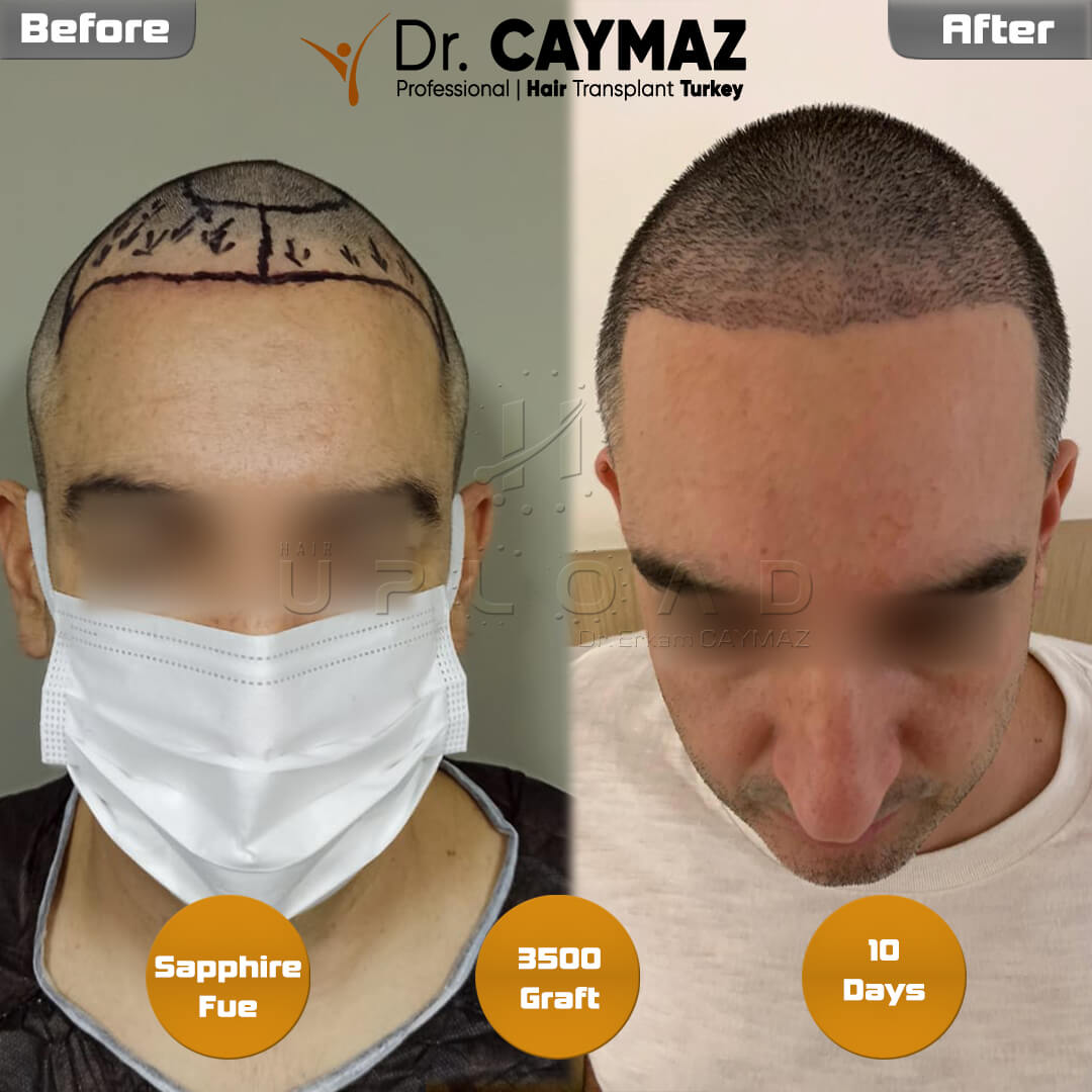 What Are The Hair Transplant Costs In Turkey | Hair Upload Clinic -  