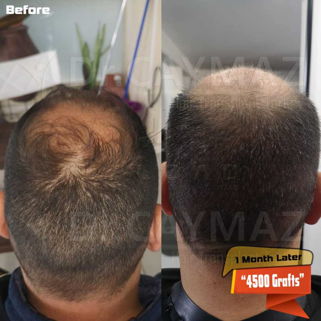 4500-grafts-1-Month-Later-Donor-Area