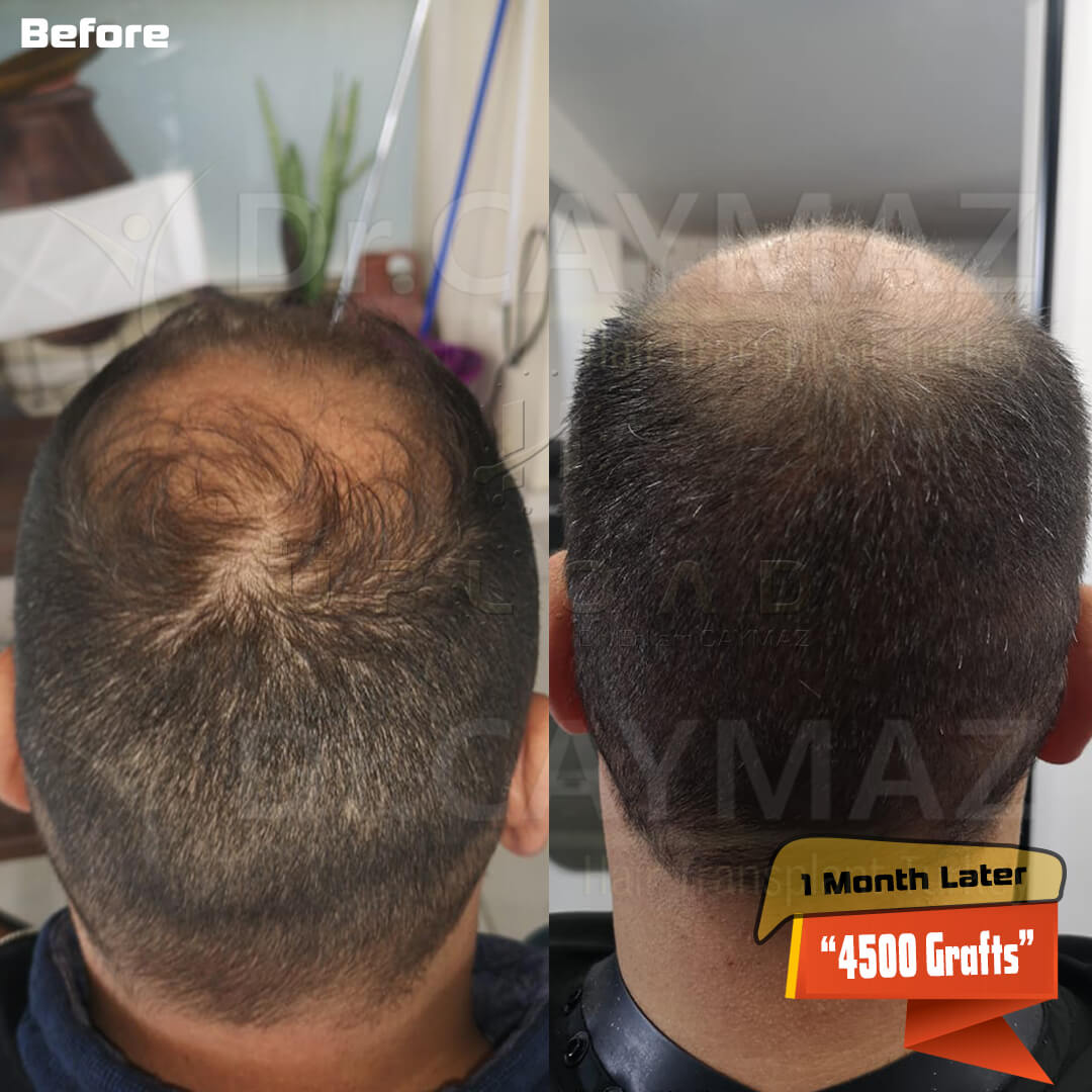 New  Details On Fue Hair Transplant Nyc