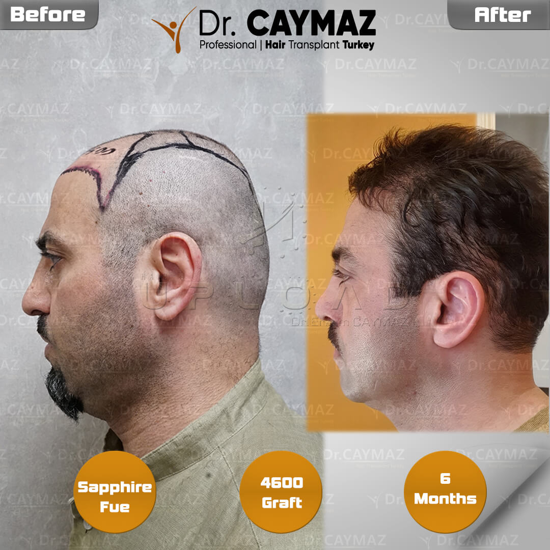 Eyebrow Transplant: Achieving Natural Direction, Density, and Lasting Results 2 4600 graft 6 months 3