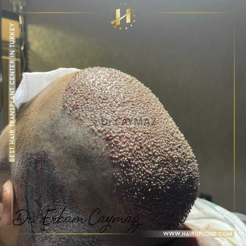 Minoxidil's Role in Hair Transplant Success: A Patient's Guide 1 Minoxidil's Role in Hair Transplant Success: A Patient's Guide