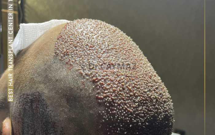 Hair Upload - Hair Transplant Turkey – Istanbul - 2026 16 4800 graft second session 6