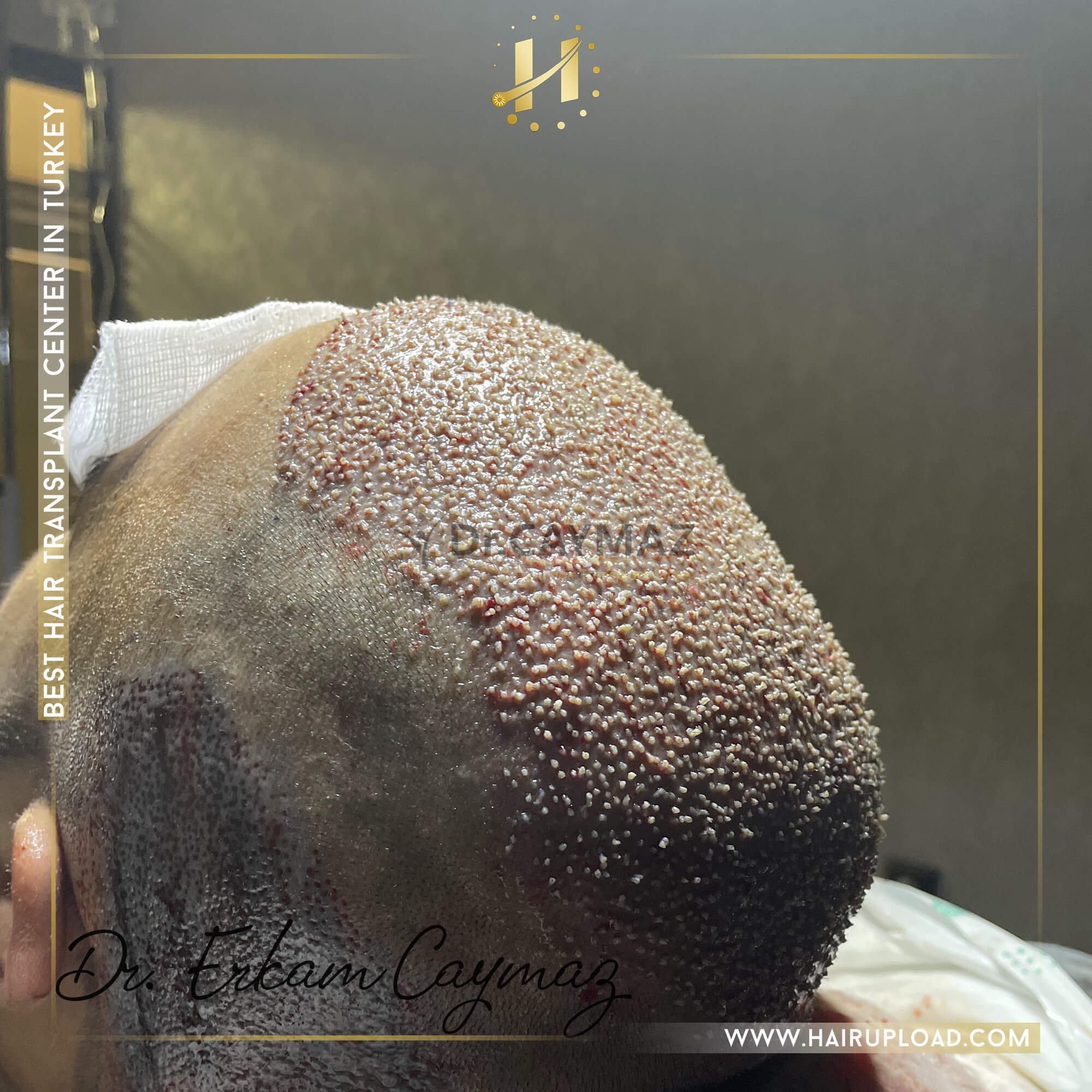Minoxidil's Role in Hair Transplant Success: A Patient's Guide 3 4800 graft second session 6