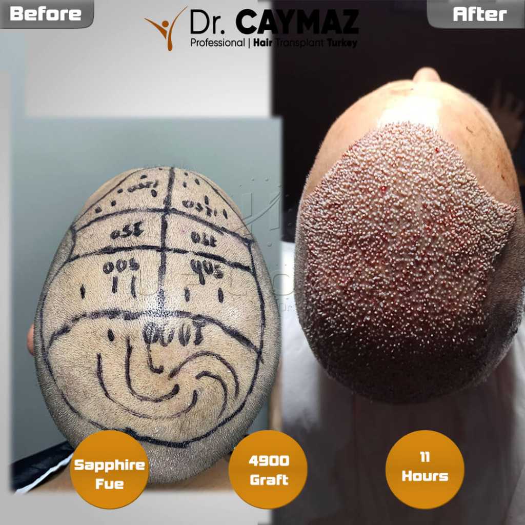 Hair Transplant and Diabetes: Pre-Operative Checks and Wound Healing 4 4900 graft 11 hours later 1