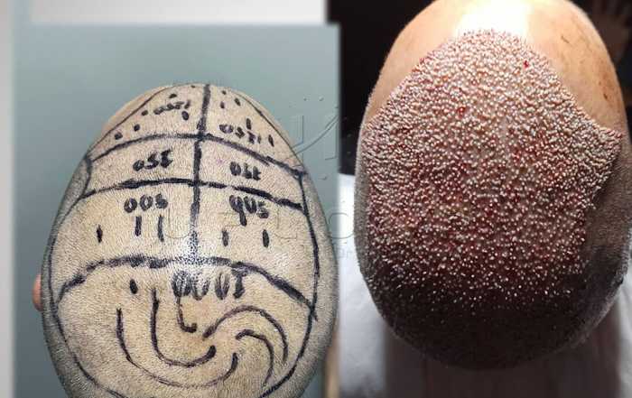 Hair Upload - Hair Transplant Turkey – Istanbul - 2026 12 4900 graft 11 hours later 1