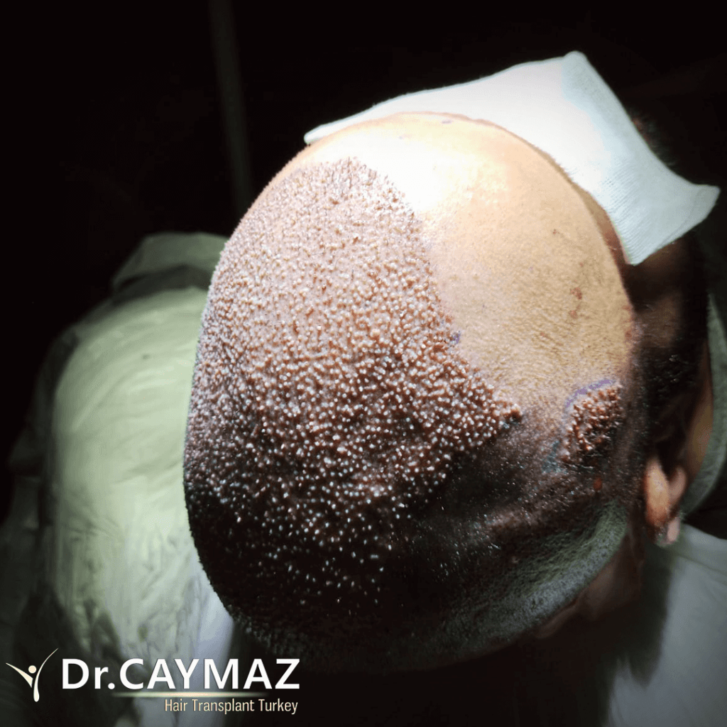 Hair Transplant and Smoking: How Nicotine Affects Graft Survival 4 4900 22