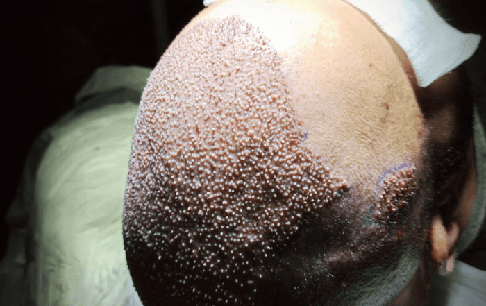 Hair Upload - Hair Transplant Turkey – Istanbul - 2026 12 4900 22