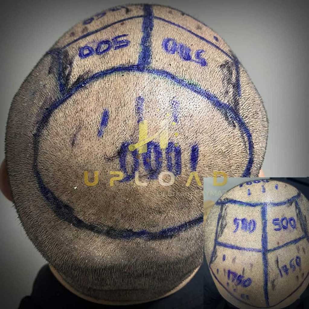 Norwood Savin Hair Loss Scale 2 5500 graft planned