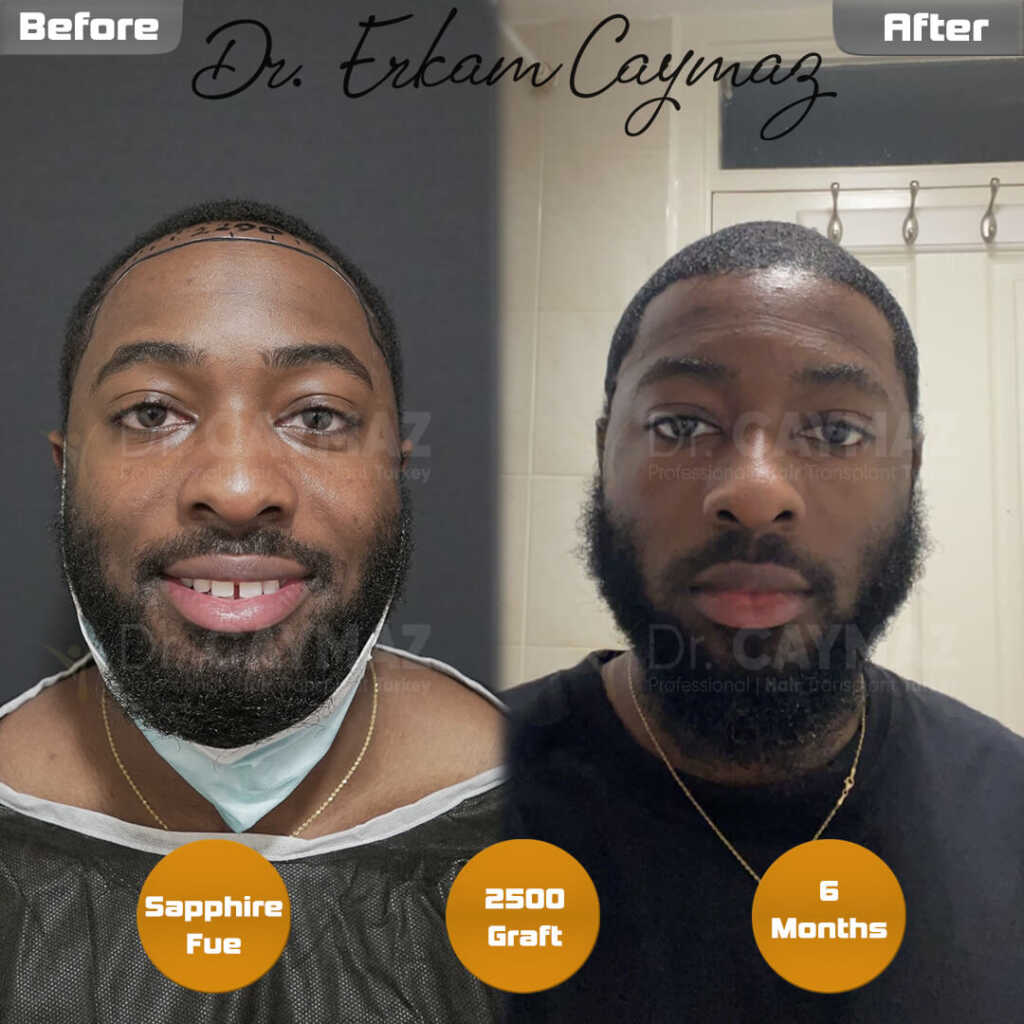 6-monhts-dr-caymaz-result 6-monhts-dr-caymaz-result