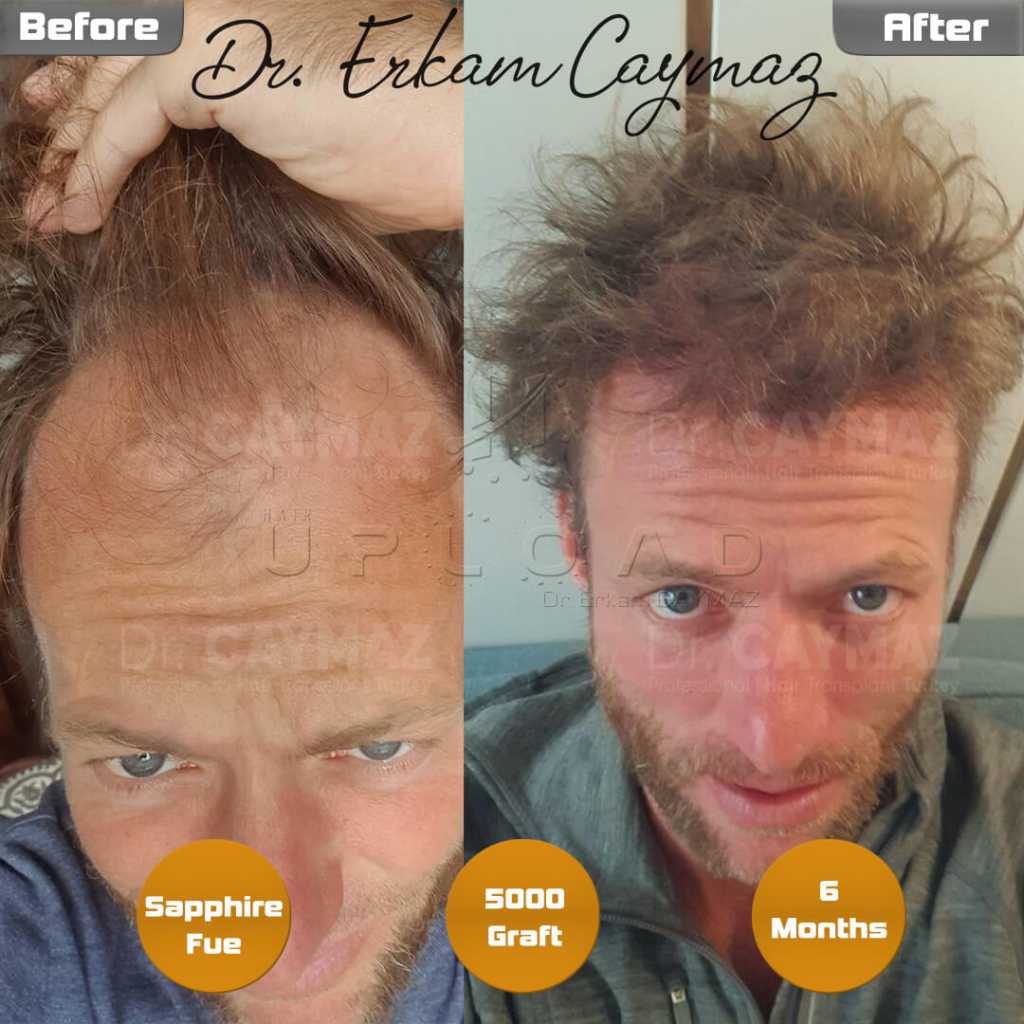 Am I a Good Candidate for Hair Transplantation? 4 6-months-later-5000-graft
