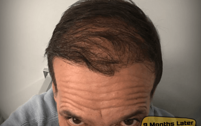 Hair Upload - Hair Transplant Turkey – Istanbul - 2026 12 9 months result