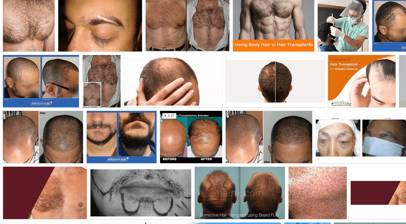Body Hair Transplantation? **2021 | Hair Upload Clinic 
