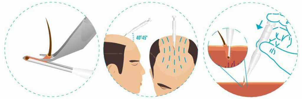DHI Hair Transplantation 2 DHI-method