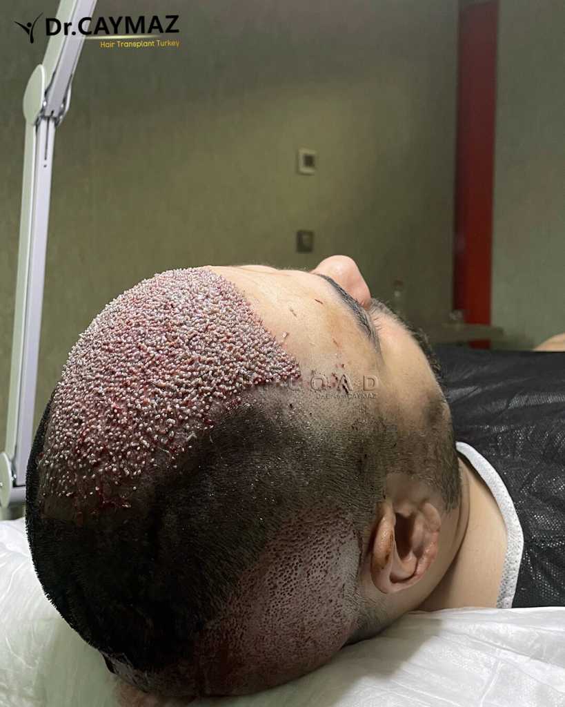 High-Density-Hair-Transplantation-4400-Graft-2