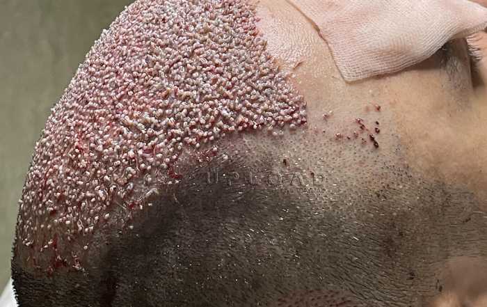 High Density Hair Transplantation 4400 Graft 3