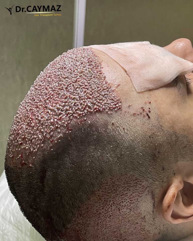 Beard Transplant After Hair Transplant: Donor Management & Design 4 High Density Hair Transplantation 4400 Graft 3