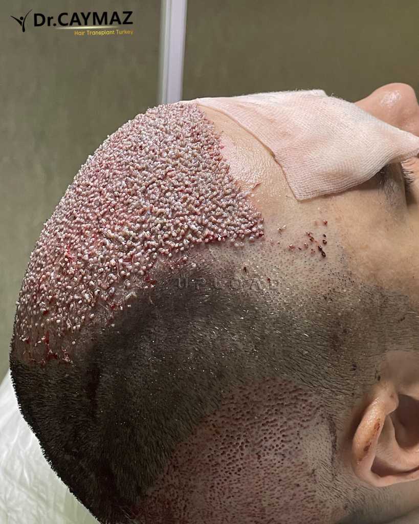 Beard Transplant After Hair Transplant: Donor Management & Design