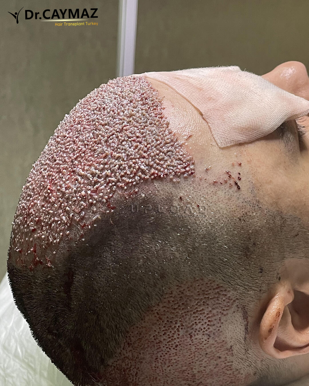 High Density Hair Transplantation 4400 Graft 3