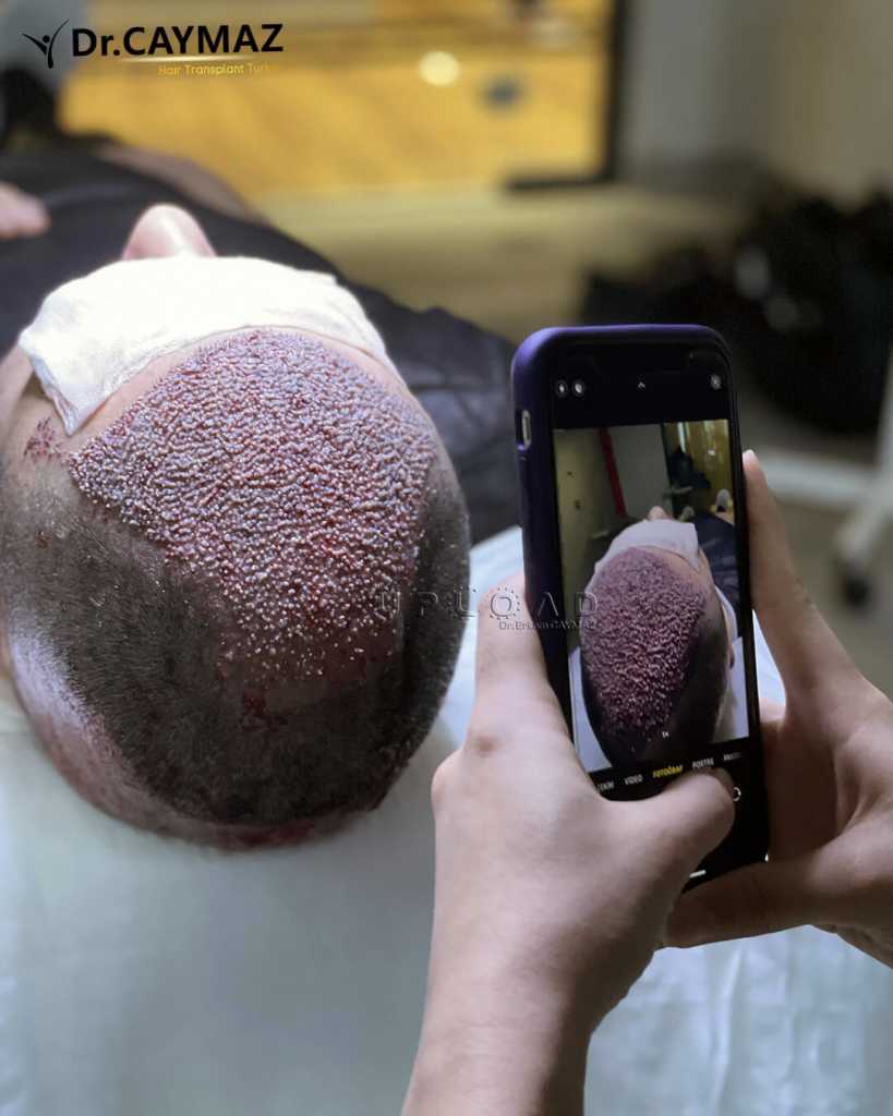 In which situations hair transplantation is not suitable? 2 High Density Hair Transplantation 4400 Graft 6