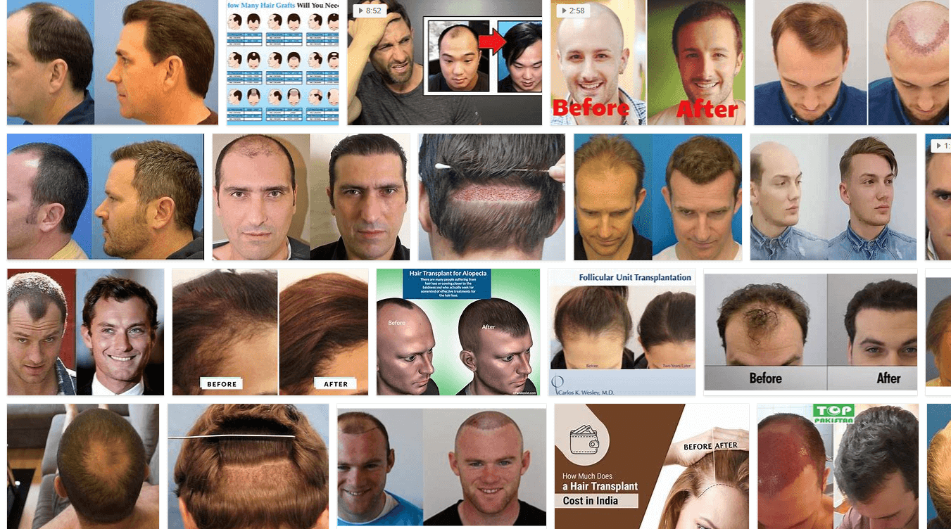 How Much is a Hair Transplant?