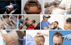 Recommendations for FUE hair transplantation