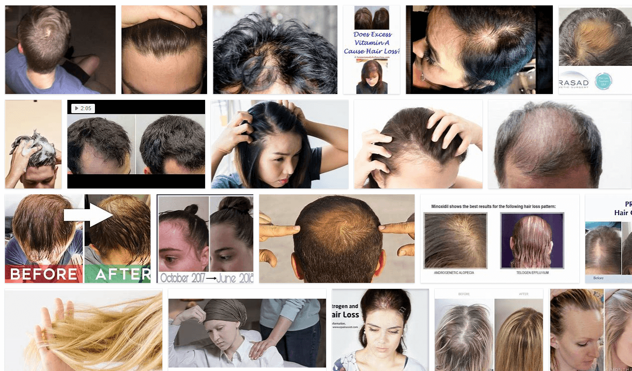 When Does Hair Loss Start? | Hair Upload Clinic 
