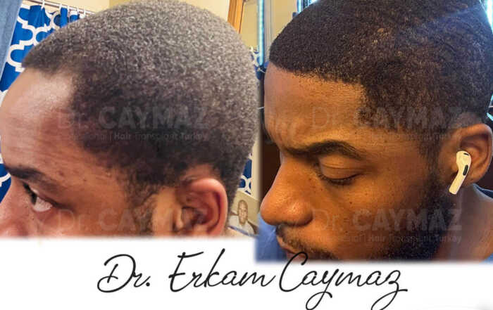 afro-12-months-left-side-result-35