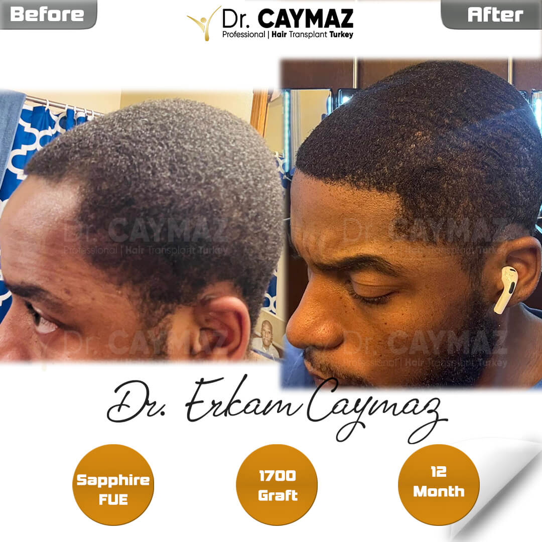 2000 Grafts Hair Transplant 1 afro-12-months-left-side-result-35