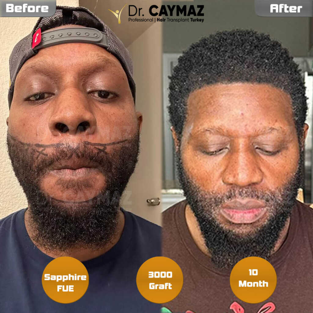 beard-10-month-result-234 beard-10-month-result-