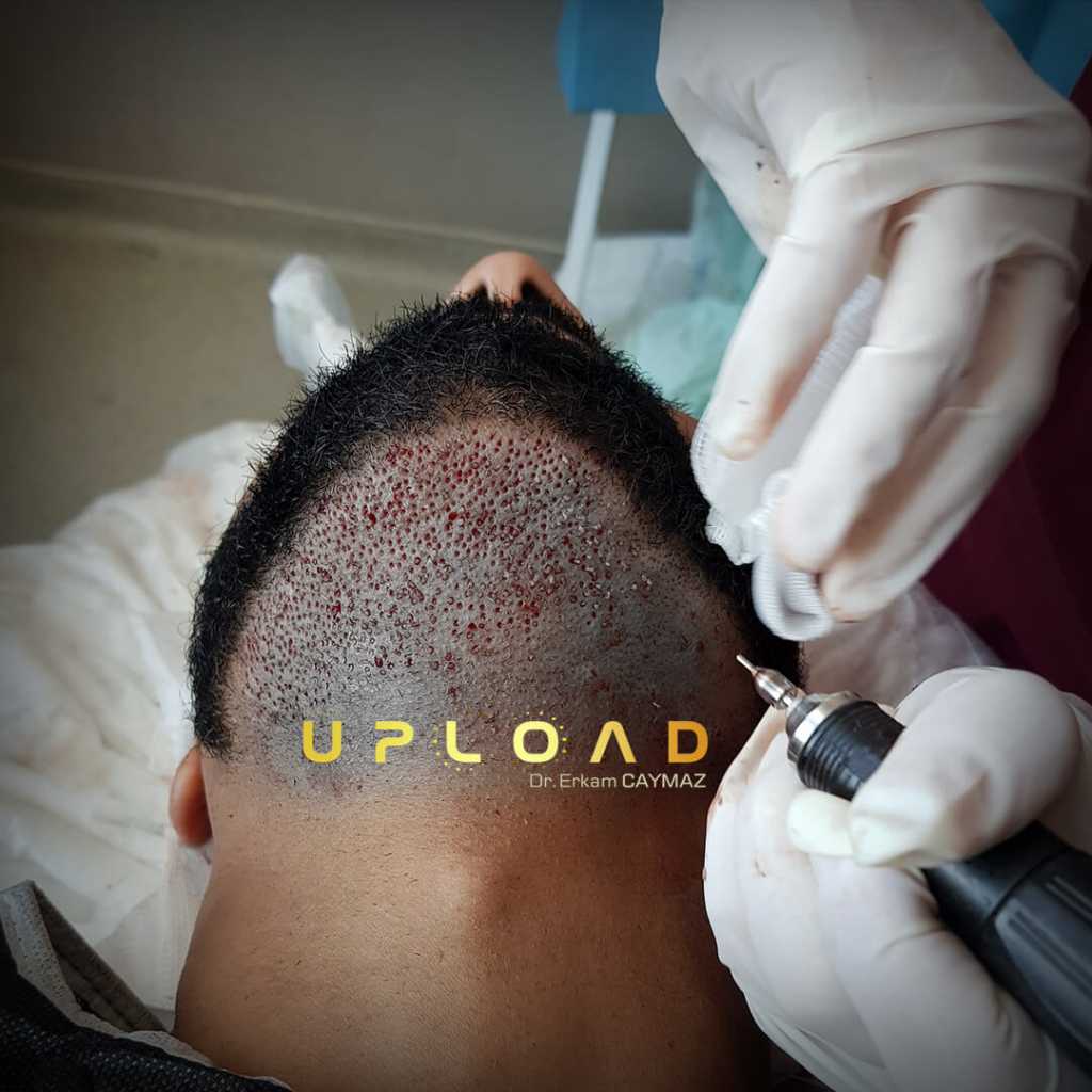 Hair Transplant Process 23 beard donor area