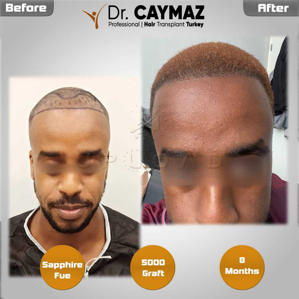 Failed Hair Transplant Repair: Evaluation Before a Corrective Plan 4 before-after-8-months-5000-graft-afro-american