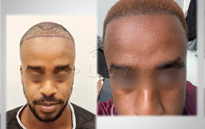 before-after-8-months-5000-graft-afro-american