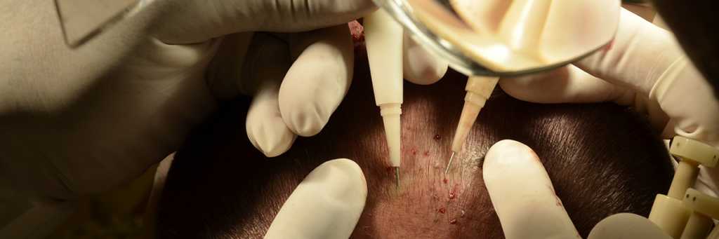 DHI Hair Transplantation 3 choi-implater-pen