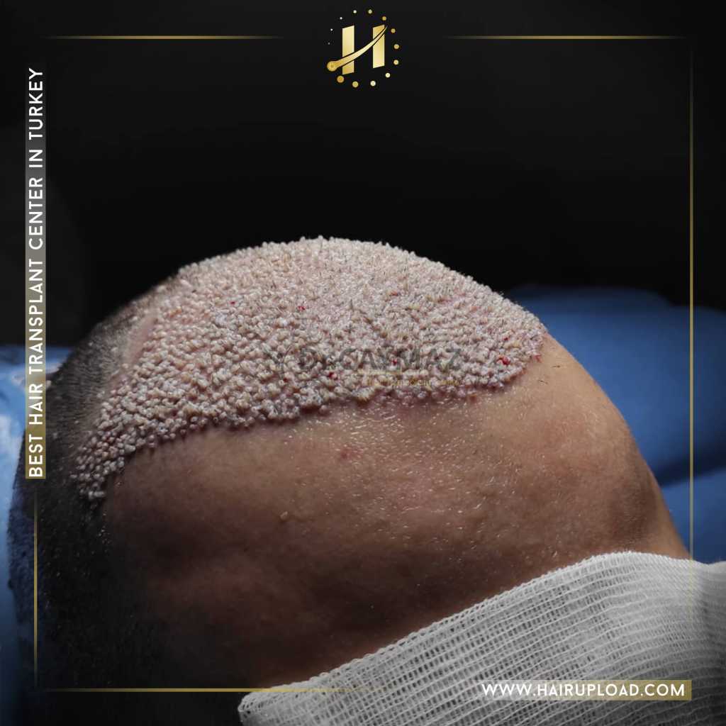 Why Should Hair Transplantation Be Preferred in Istanbul? 2 dense-hair