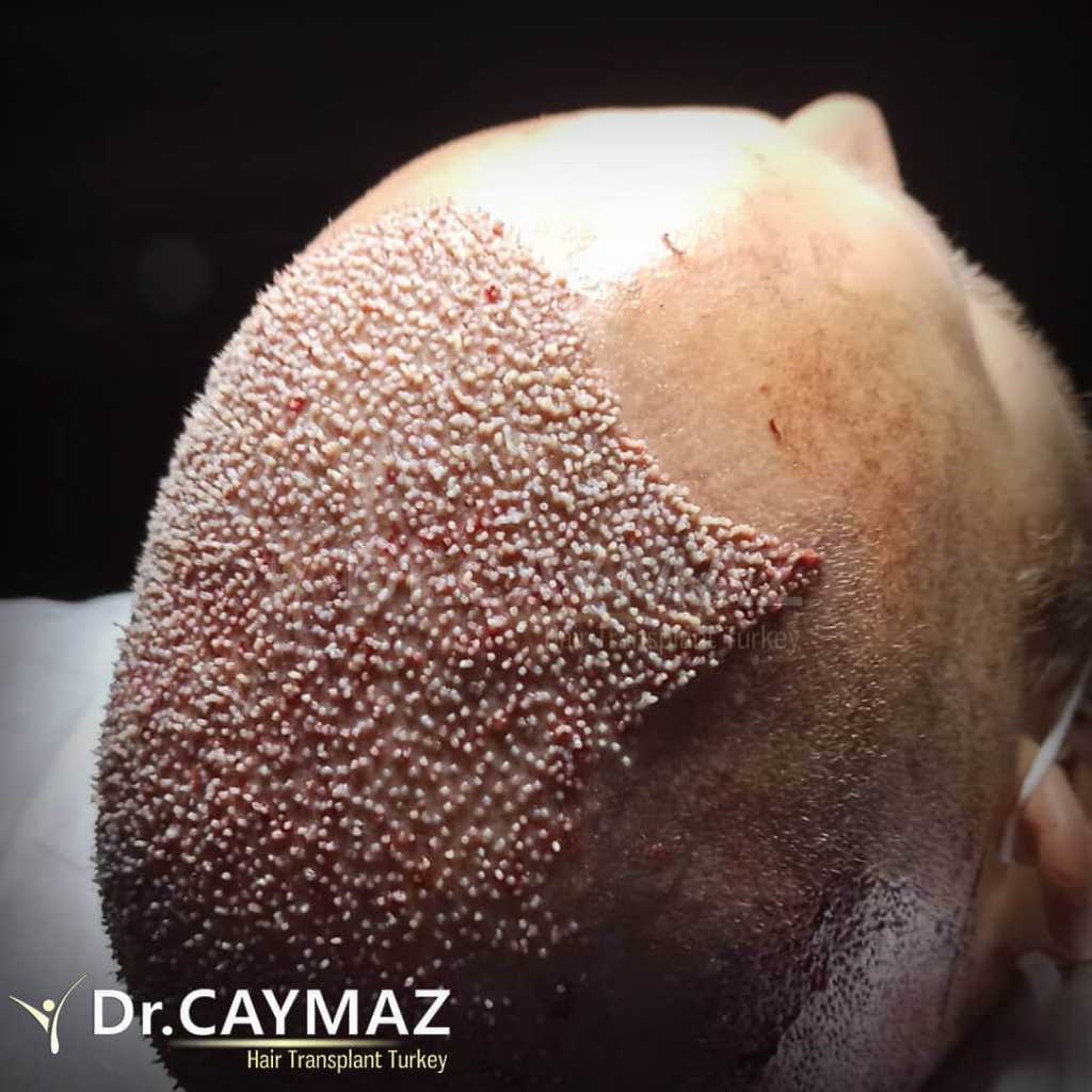 Hair Transplant Process 17 hair grafts ice