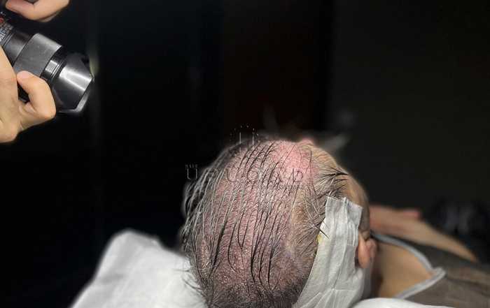 dhi direct hair implantation 236