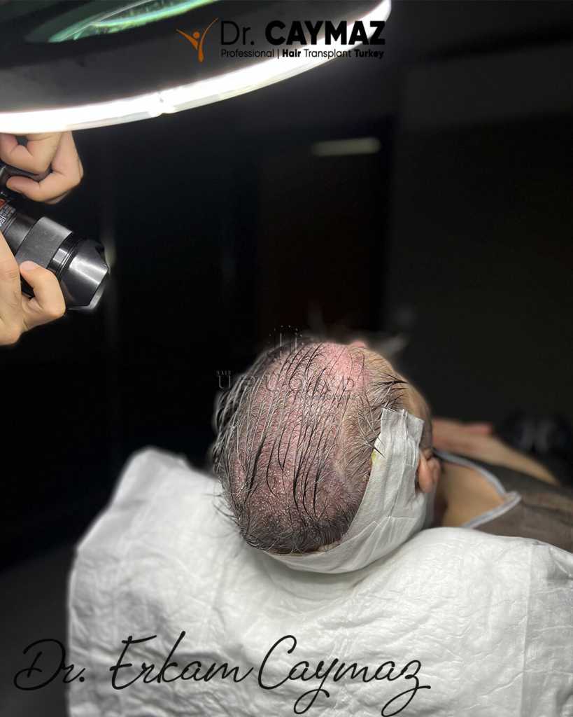 Female Hair Transplant: Candidacy, Donor Area, and Realistic Expectations 1 Female Hair Transplant: Candidacy, Donor Area, and Realistic Expectations
