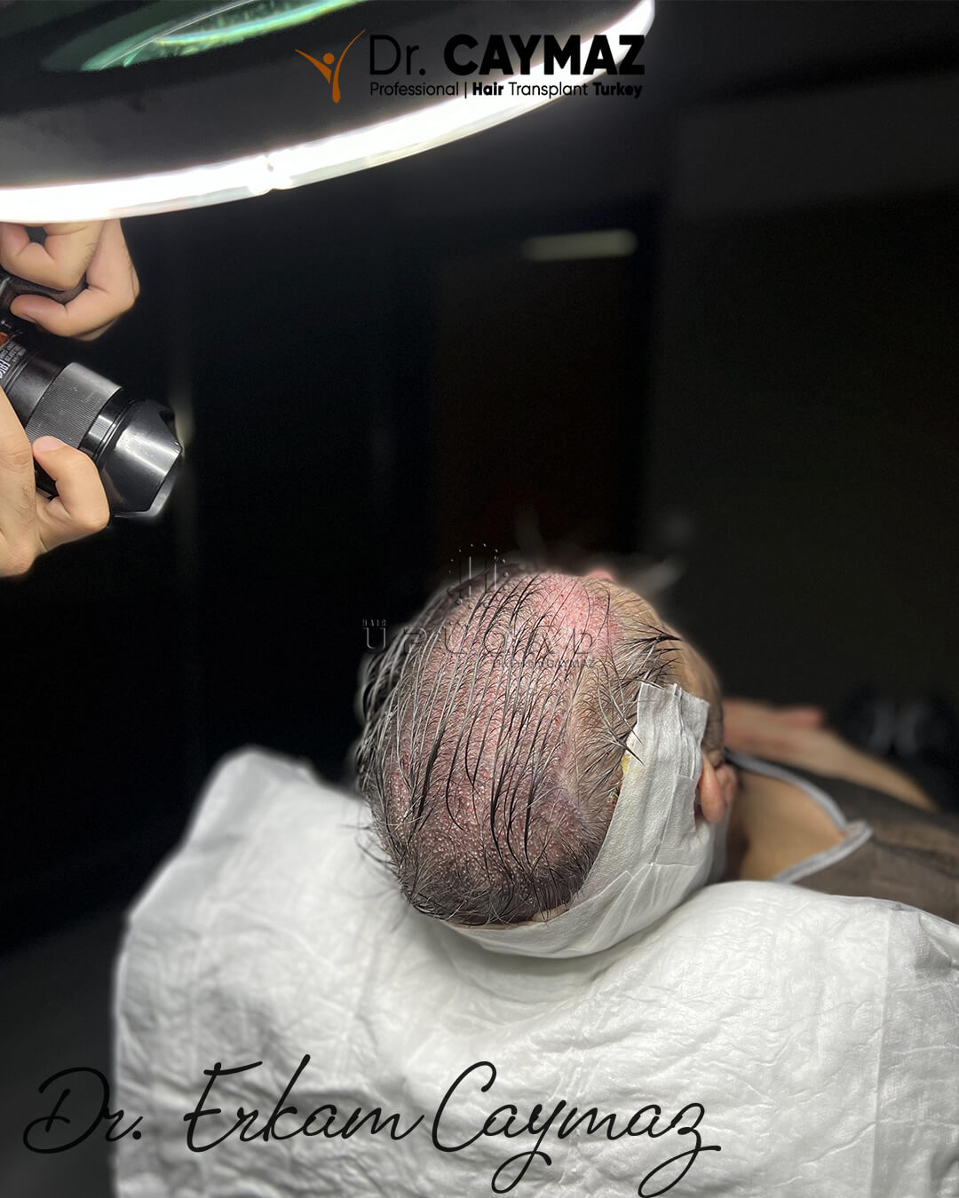 Female Hair Transplant: Candidacy, Donor Area, and Realistic Expectations 14 dhi direct hair implantation 236