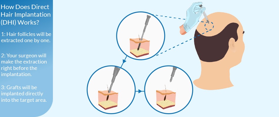DHI Hair Transplantation 1 dhi-direct-hair-implantation