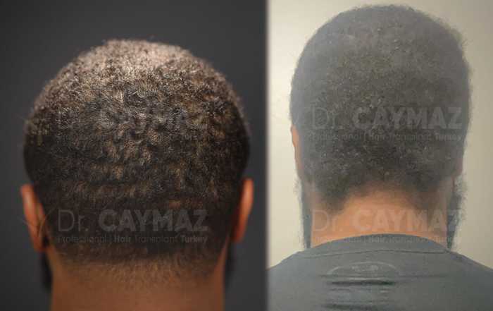 Hair Upload - Hair Transplant Turkey – Istanbul - 2026 12 donor areas result 5 months