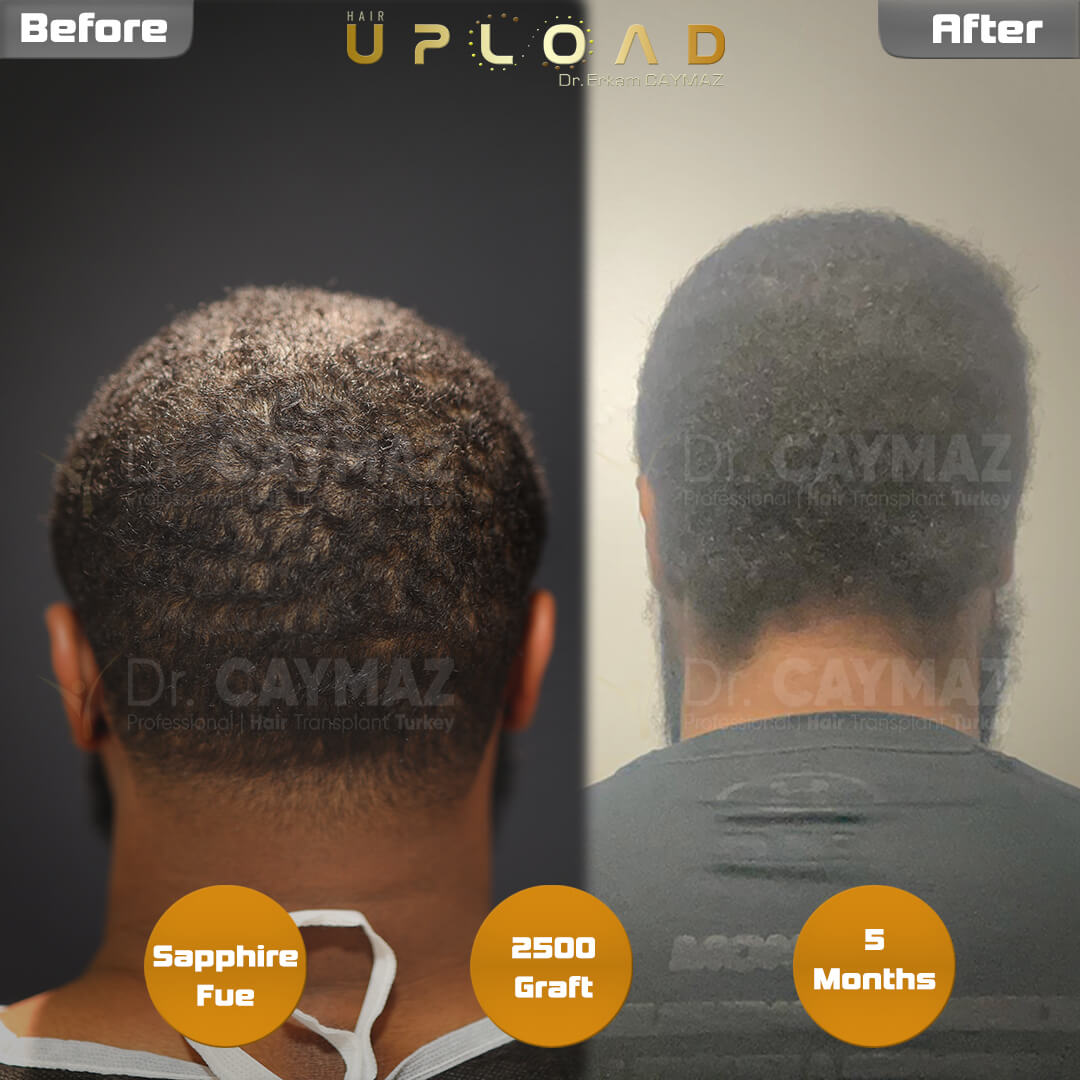 Sapphire FUE Blades: Precision in Hair Transplant Incisions 1 donor areas result 5 months