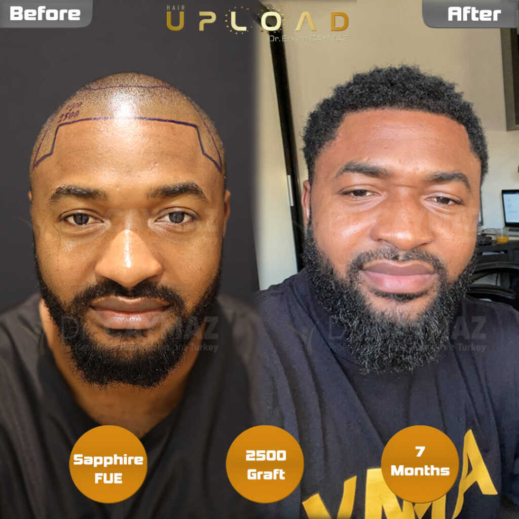 dr-caymaz-7-months-afro-american-hair-transplant-result dr-caymaz-7-months-afro-american-hair-transplant-result