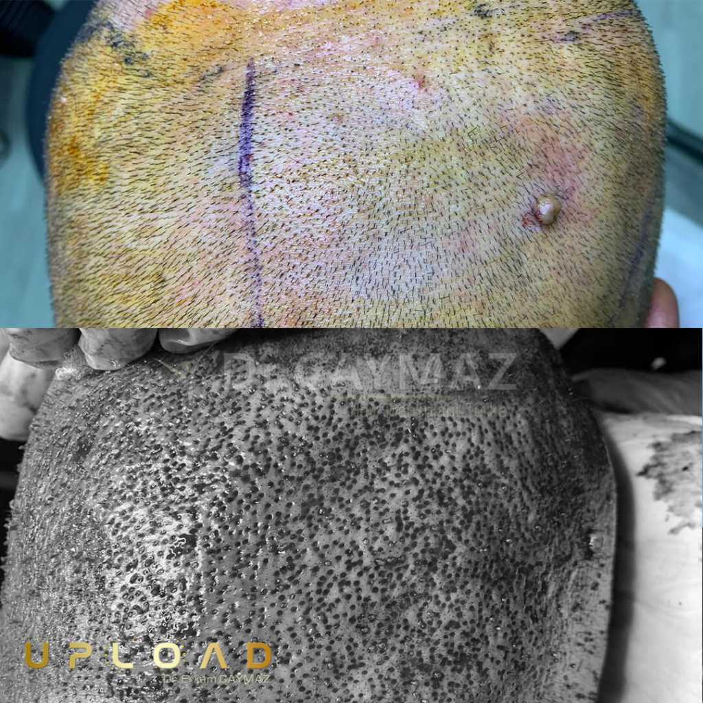 Hair Transplant Process 5 extracted