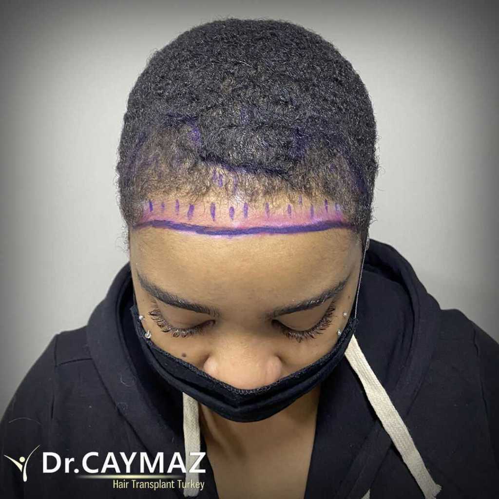 female-hairline-design hair transplant turkey istanbul