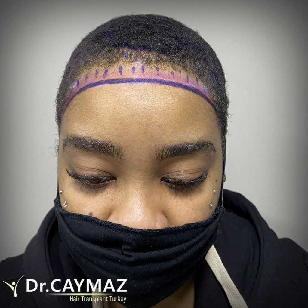 female-hairline-design-2 hair transplant turkey istanbul