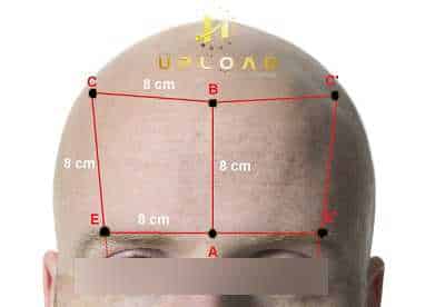 Natural Hairline Design: Guide for Men & Women 7 hair transplant turkey istanbul